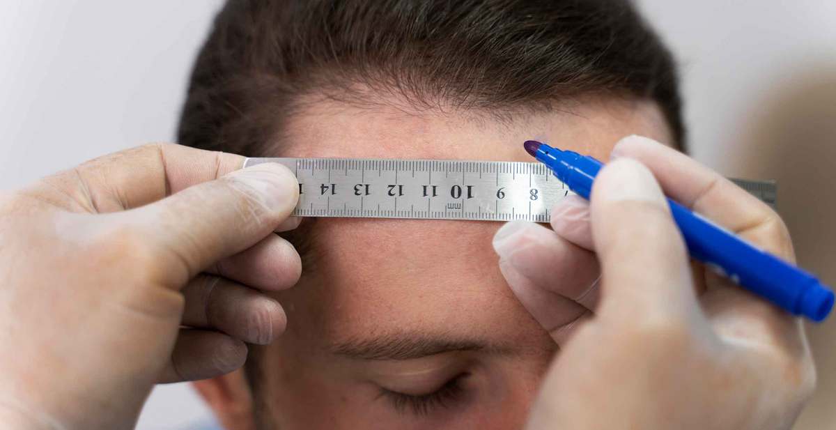 7 Cara Mengatasi Receding Hairline Pada Pria